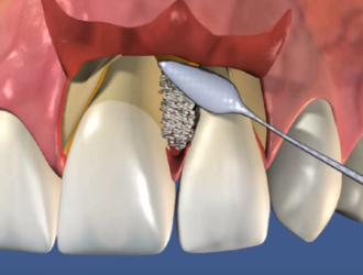 Операции по сохранению зубов