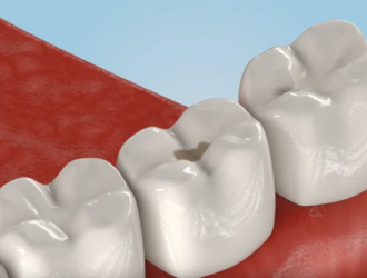 Лечение постоянных зубов детям до 14 лет