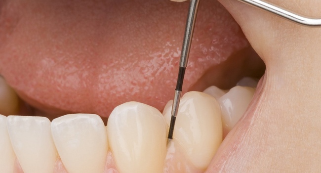 Лечение острых заболеваний зубов