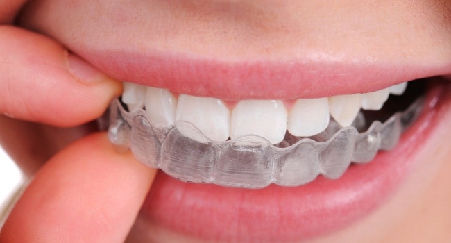 Стоимость отбеливания зубов